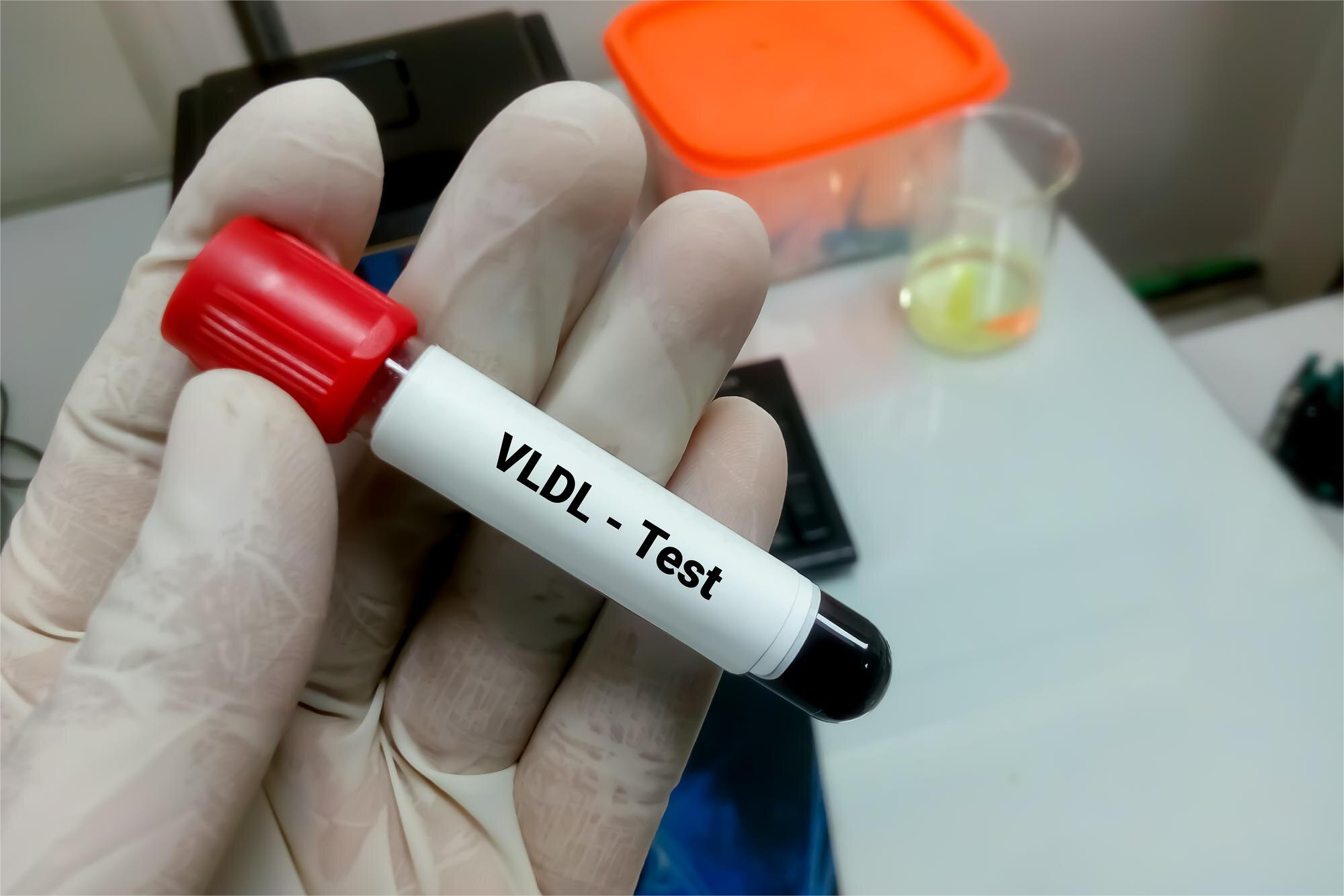 LIPOSCALE TEST AVANZADO DE LIPOPROTEINAS