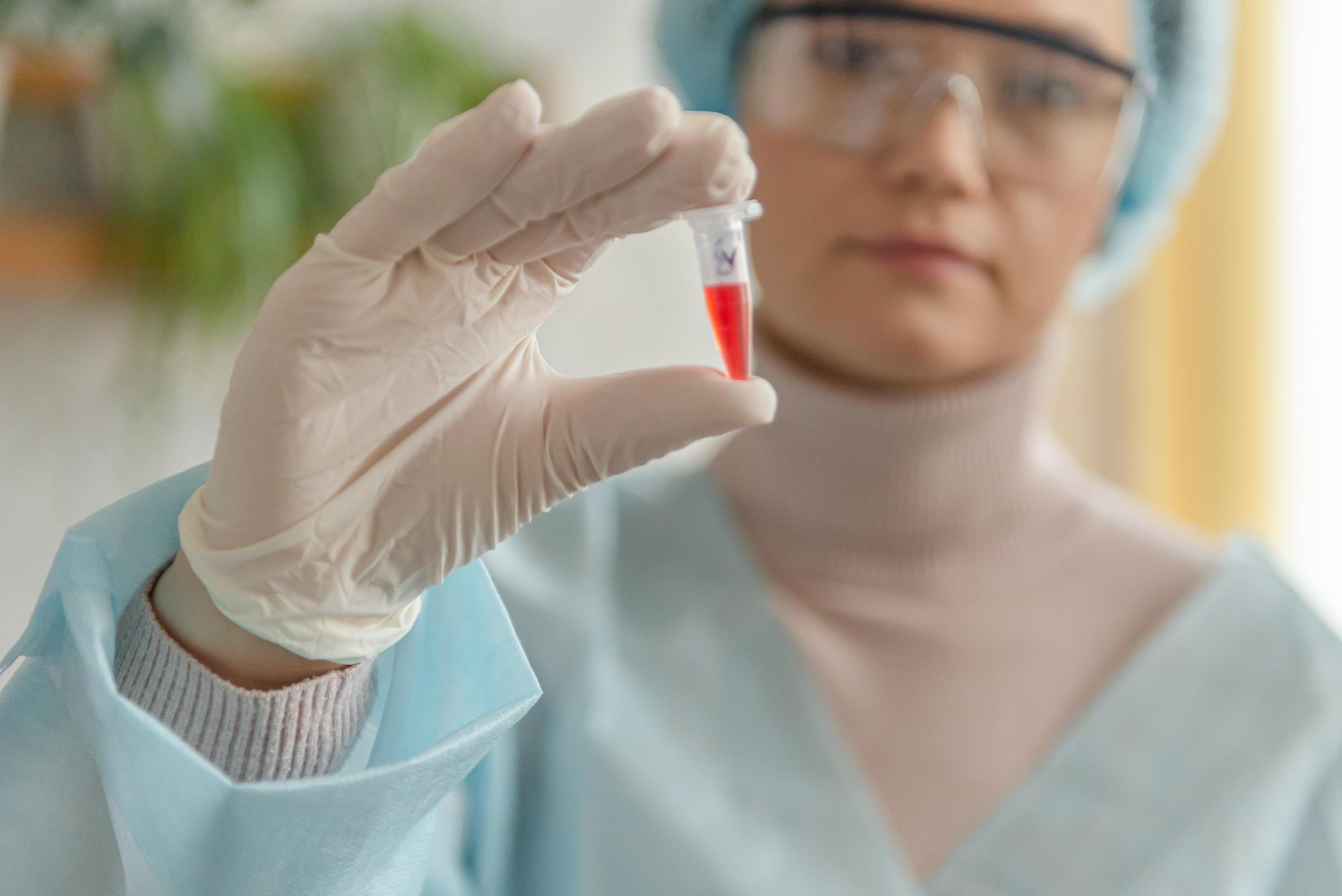 BILIRRUBINA INDIRECTA SUERO (COLEMIA INDIRECTA)