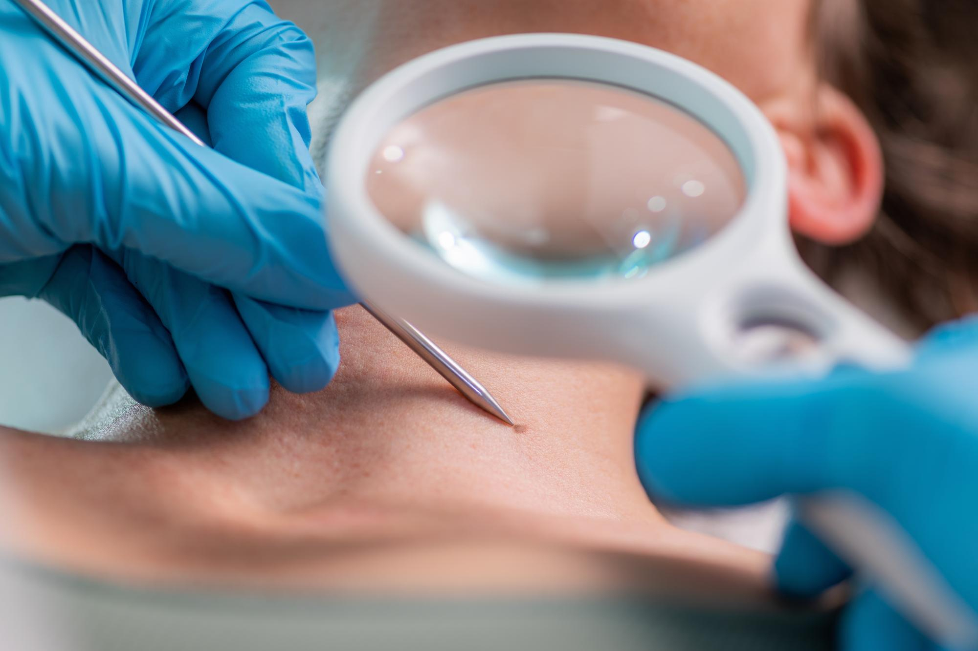 BIOPSIA PIEZA PEQUEÑA