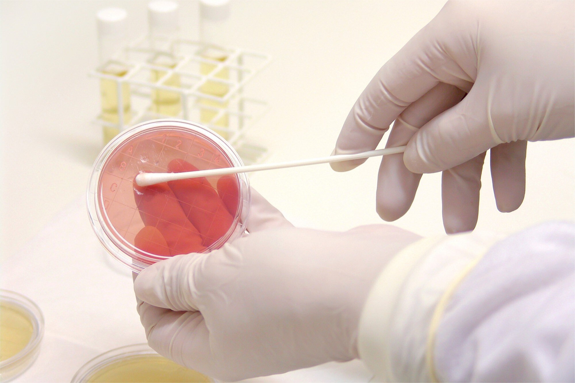 CALPROTECTINA EN HECES