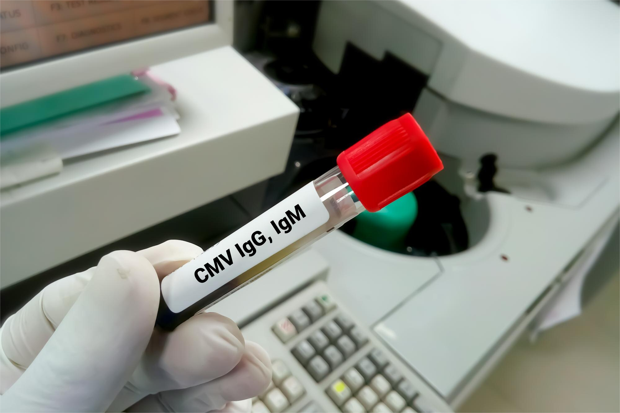 CITOMEGALOVIRUS AC. IGM