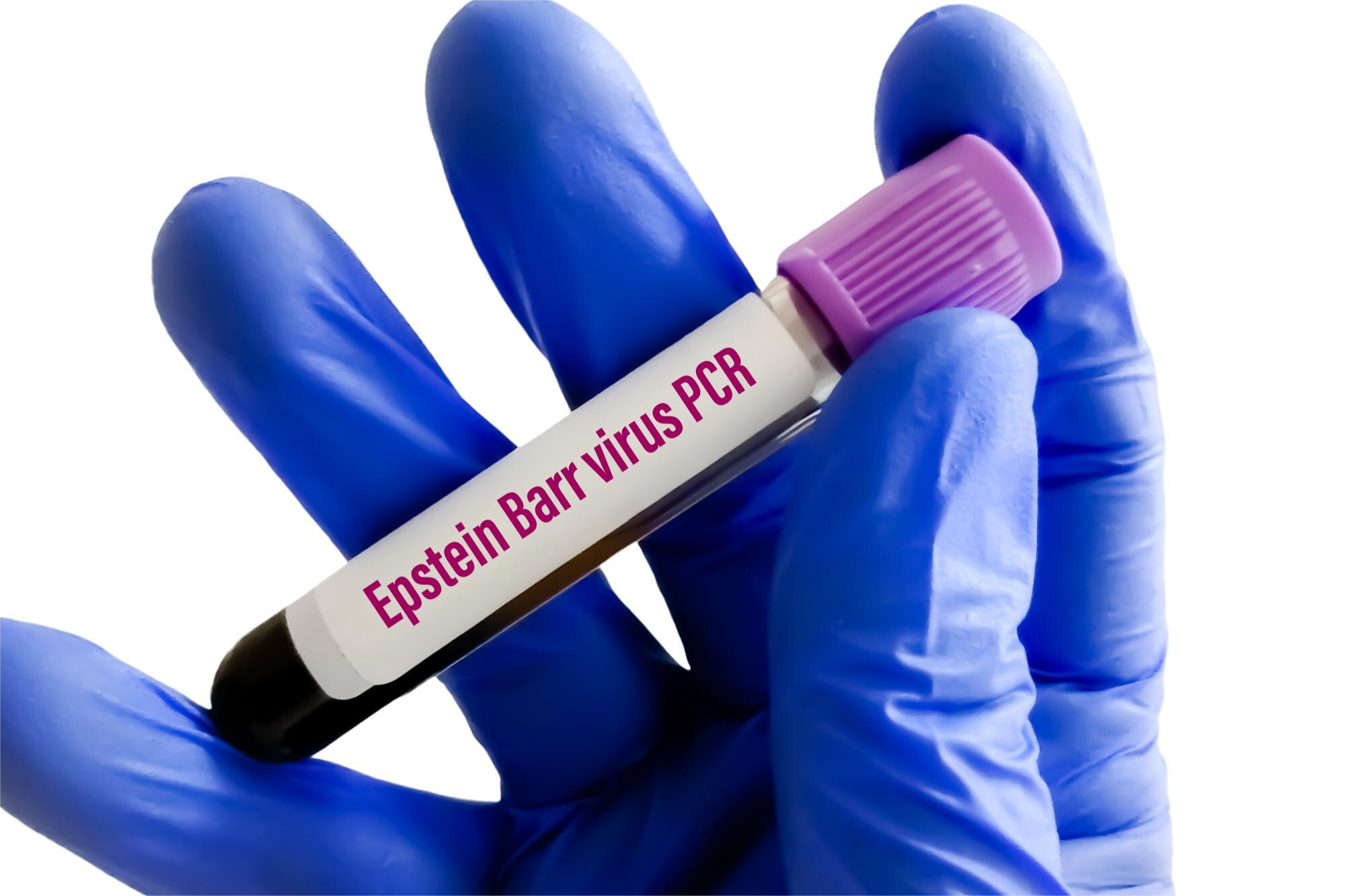 EPSTEIN-BARR AC. NUCLEAR ANTIGEN (EBNA) IGG