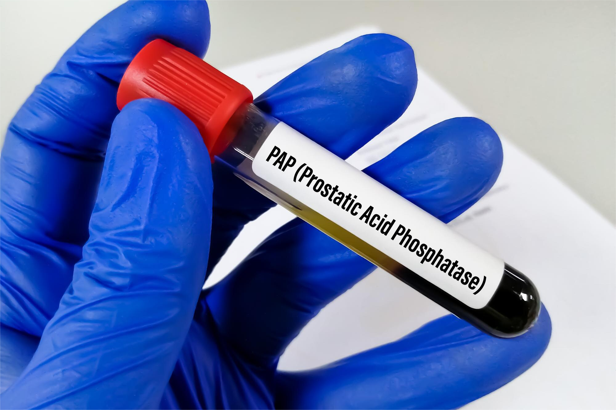 FOSFATASA ACIDA PROSTATICA