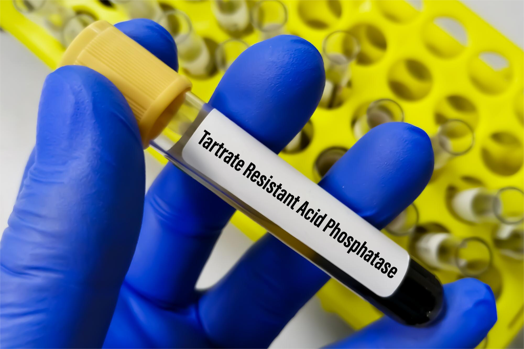 FOSFATASA ACIDA TOTAL