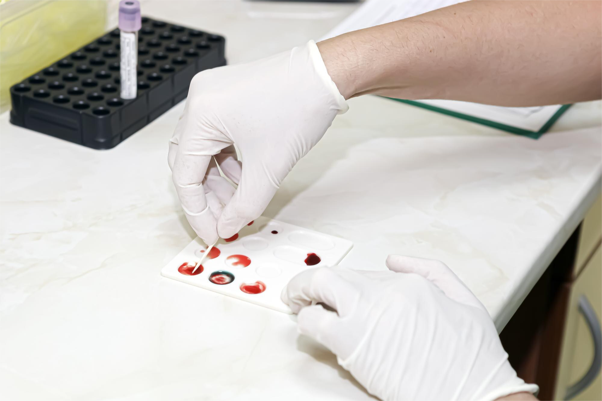 GLUTATION PEROXIDASA ERITROCITARIA