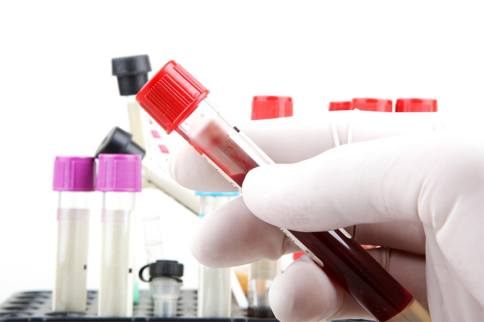 Genotipo de receptores KIR en sangre