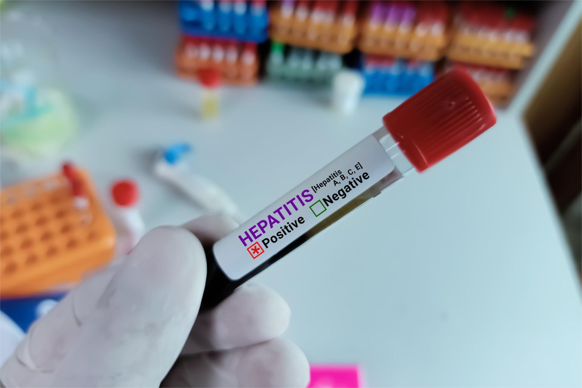 HBV DNA PCR Cualitativa (hepatitis B)