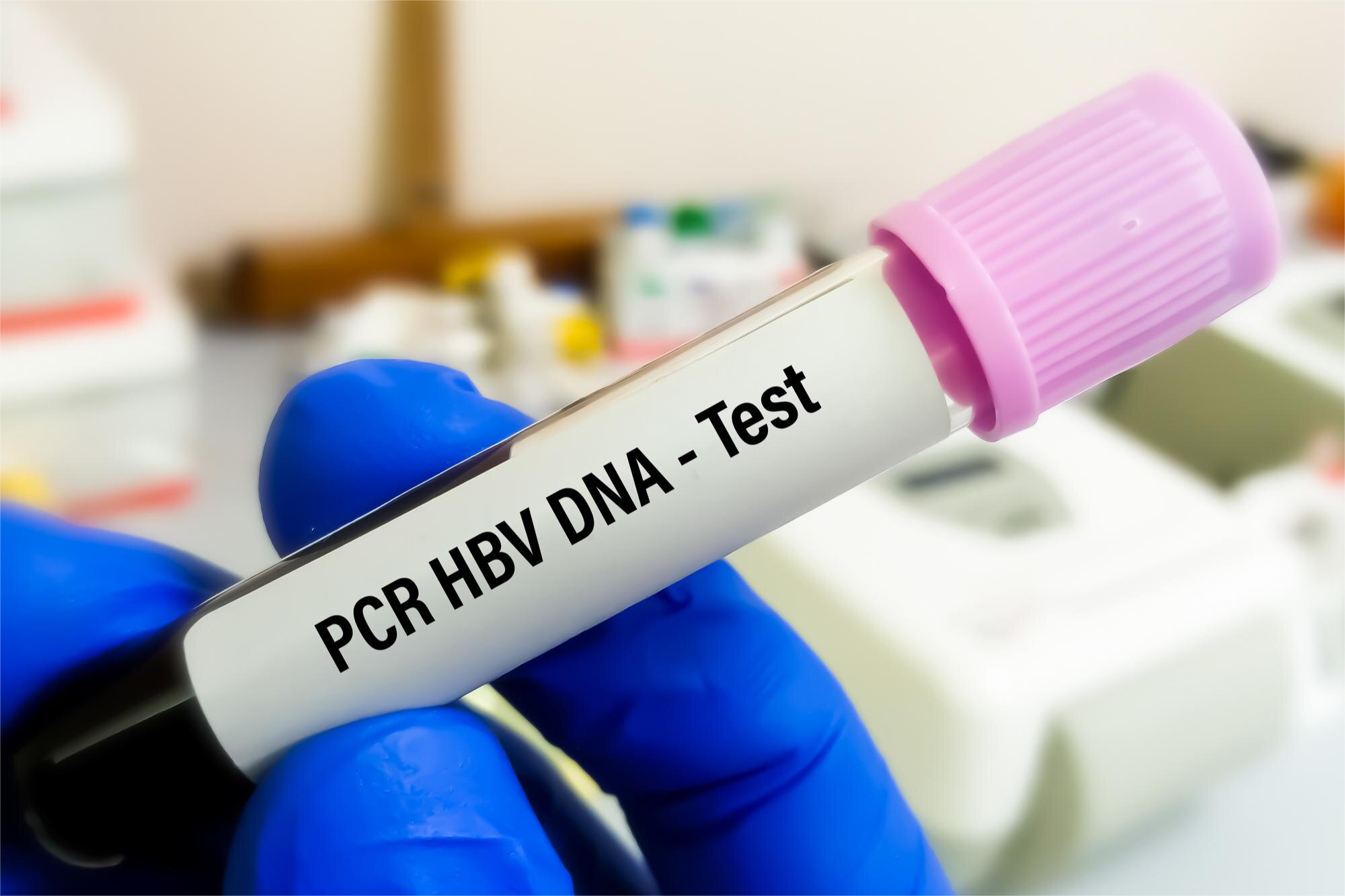 HBV DNA PCR Cuantitativa (hepatitis B)