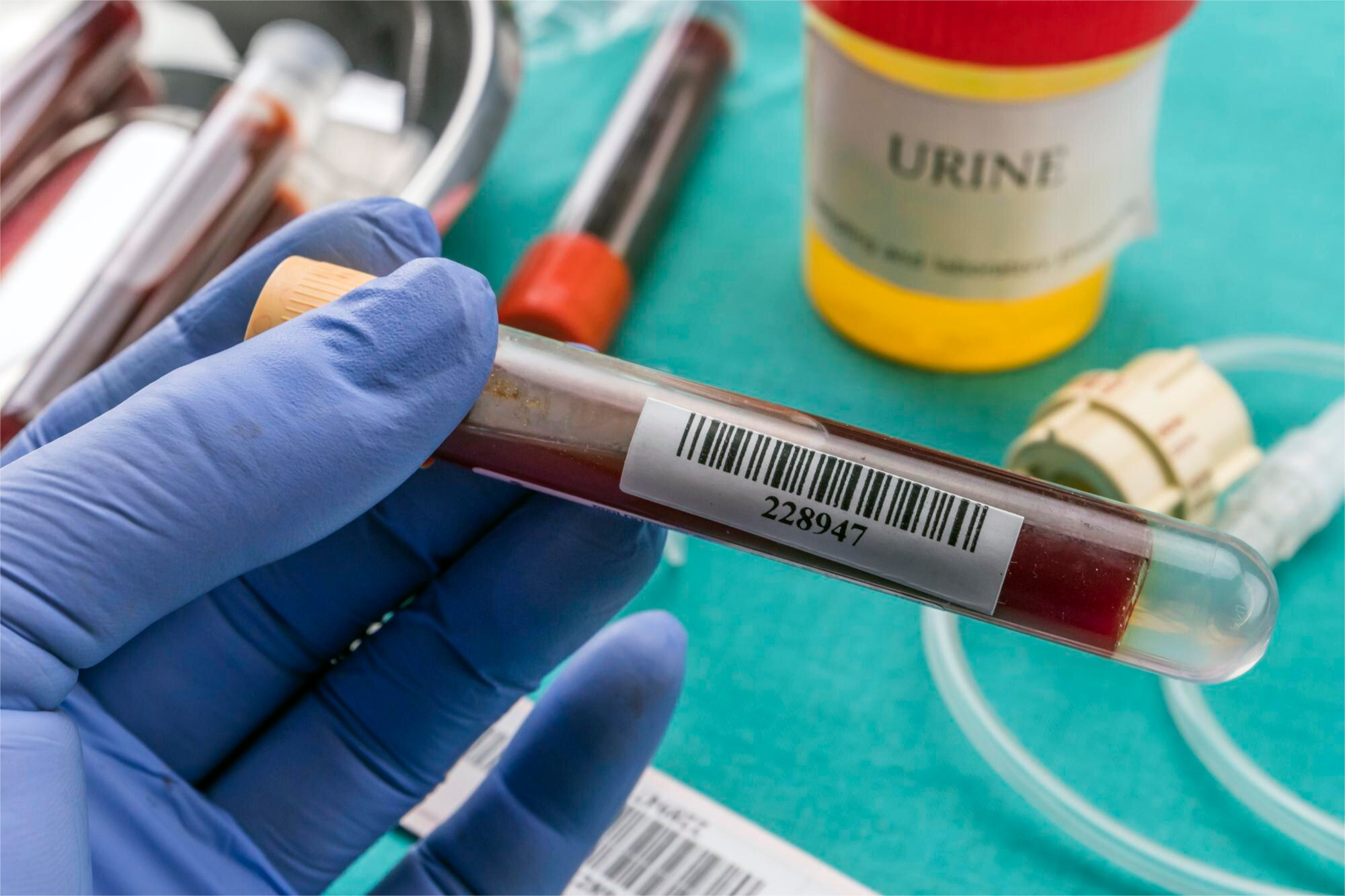 HEMOGLOBINA GLICOSILADA (HbA1c)