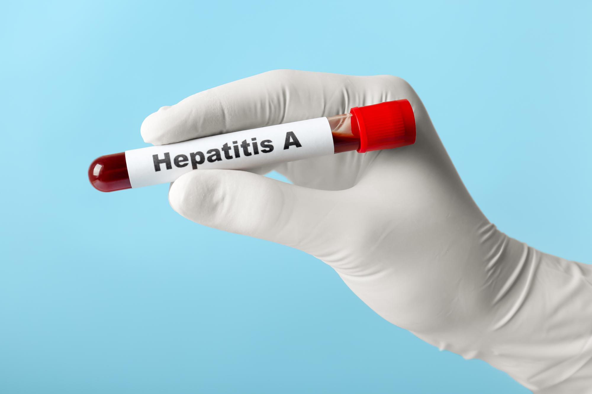 HEPATITIS A AC. IGM