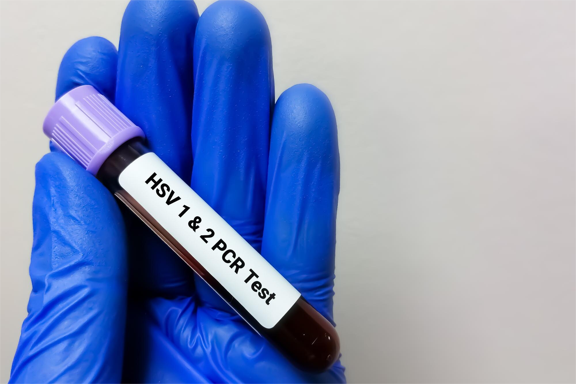 Herpes 1 y 2 PCR Cualitativa + Genotipo