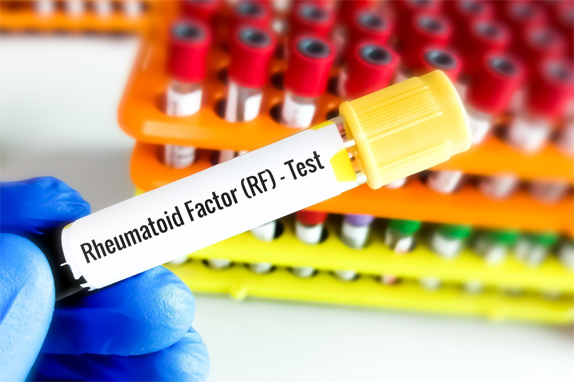 LATEX-FR (FACTOR REUMATOIDE)