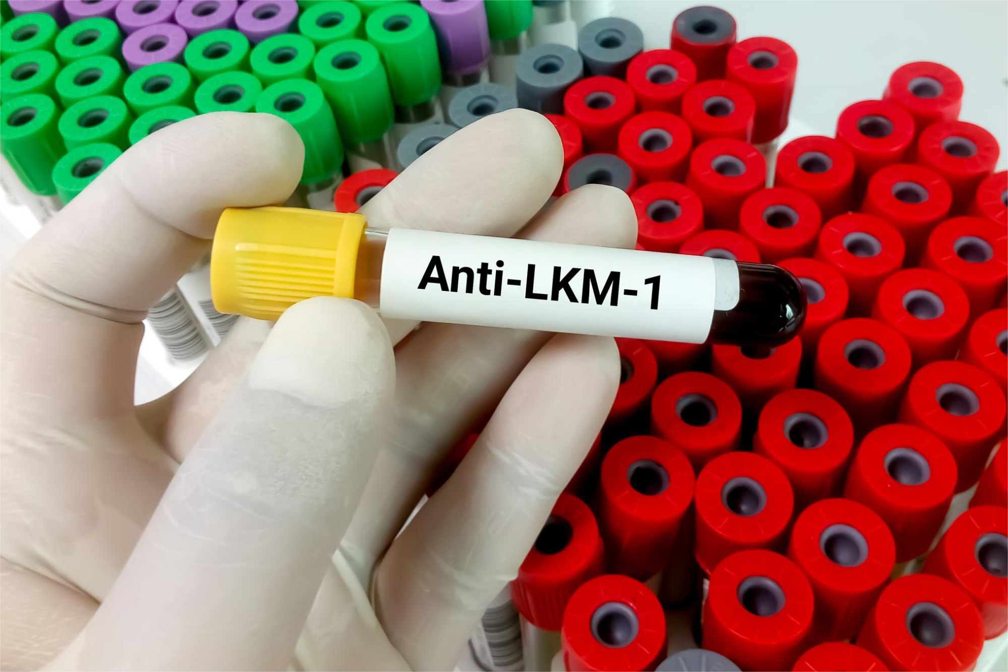 MICROSOMALES AC. SUERO (ANTI-TPO)