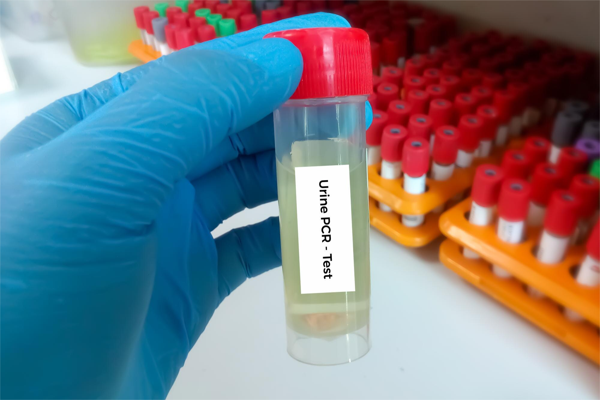 PROTEINAS ORINA 24HORAS